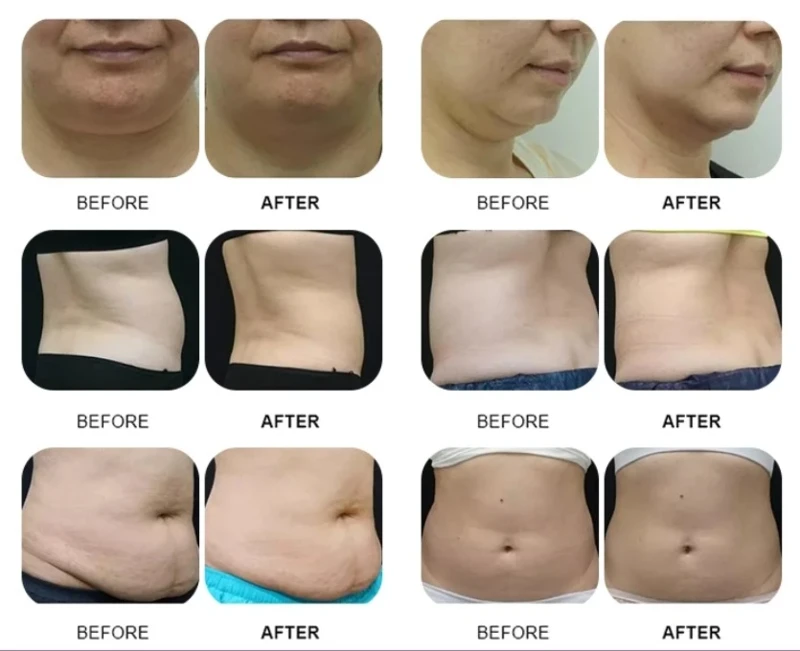 Cryotherapy Body Sculpt Machine 14 Cryotherapy Body Sculpt Machine 14