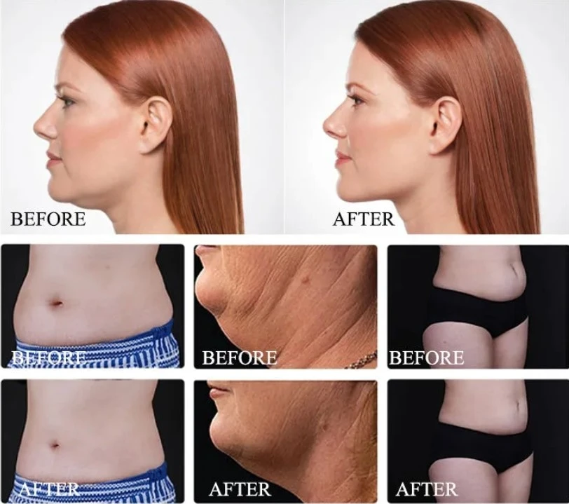 Cryolipolysis slimming machine 