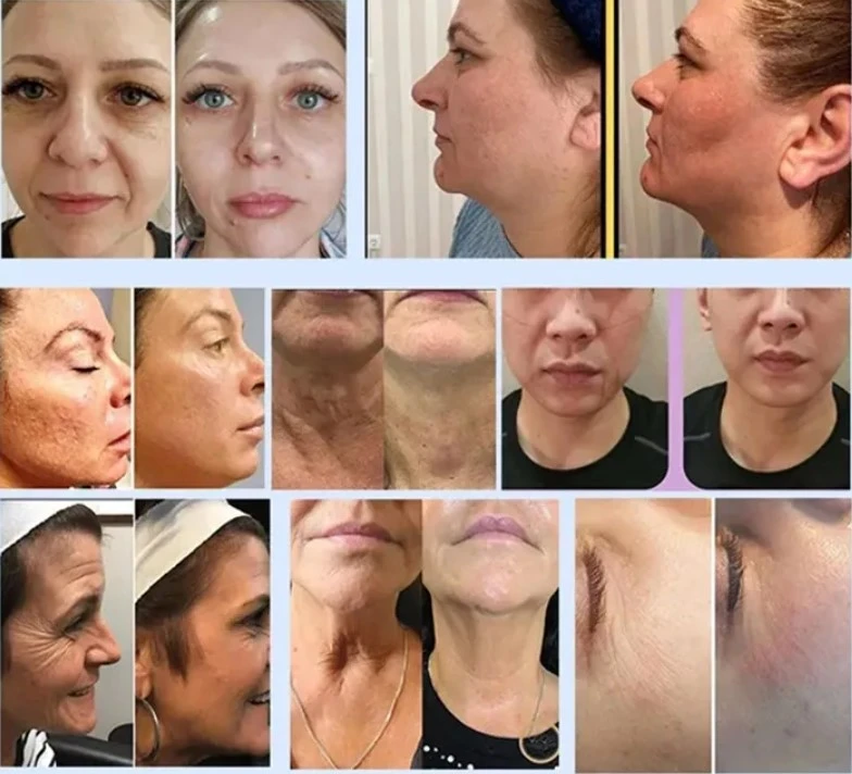 12D Ultrasonic Face Lifting Machine 10 12D Ultrasonic Face Lifting Machine 10