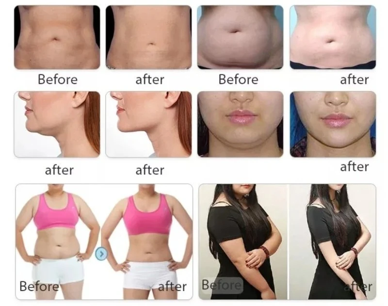 Cryolipolysis cooling shape machine 7 Cryolipolysis cooling shape machine 7