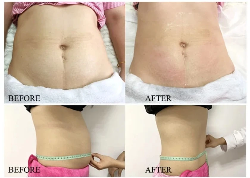 360 Cryoslim Machine 9