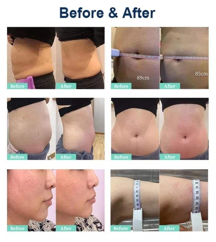 Cellulite Reduction Cryolipolysis Machine 6 Cellulite Reduction Cryolipolysis Machine 6
