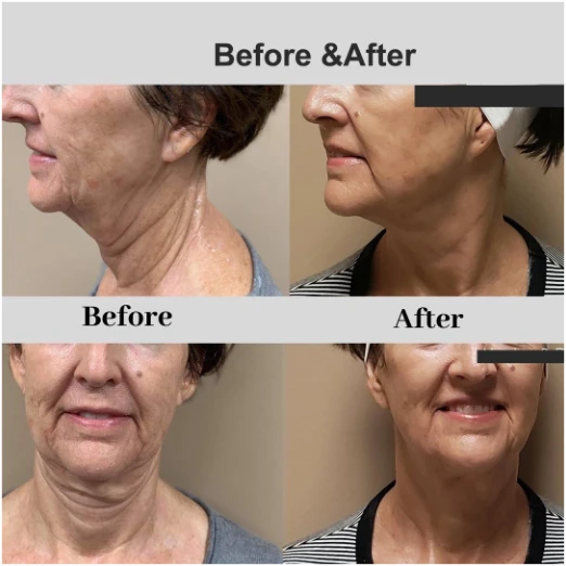 Fractional RF Microneedling Morpheus 8 Machine 5