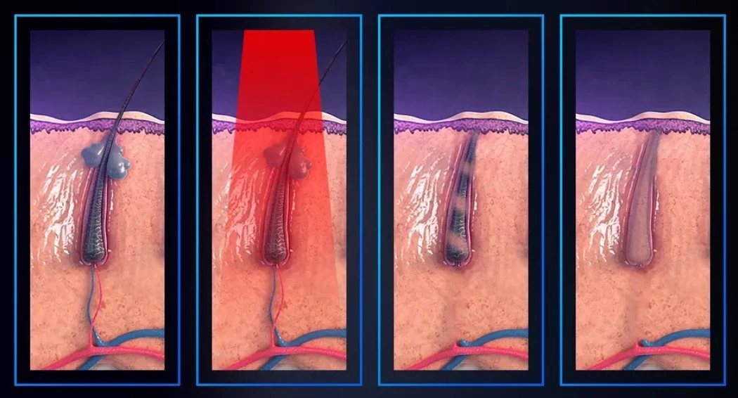 principle of hair remove principle of hair remove