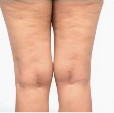 cellulite removal
