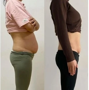 fat removal