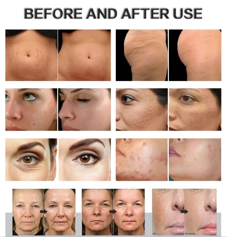 Morpheus 8 before and After