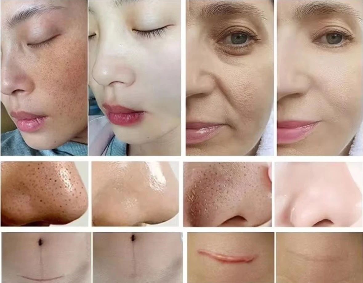 9 in 1 Hydro Microdernabrasion Machine